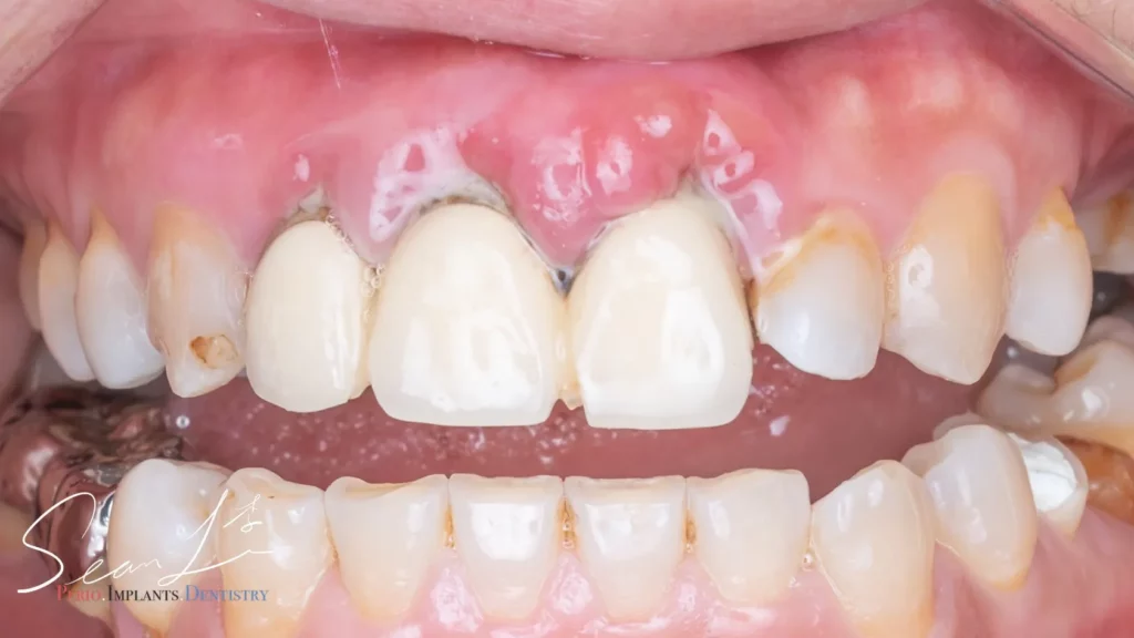 Periodontics - 天母波士頓牙醫診所