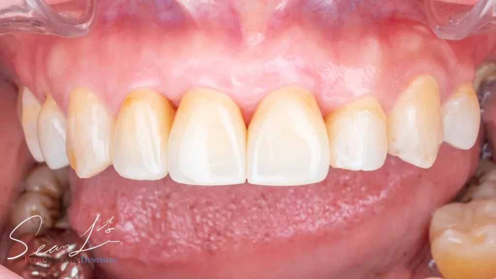 Periodontics - 天母波士頓牙醫診所